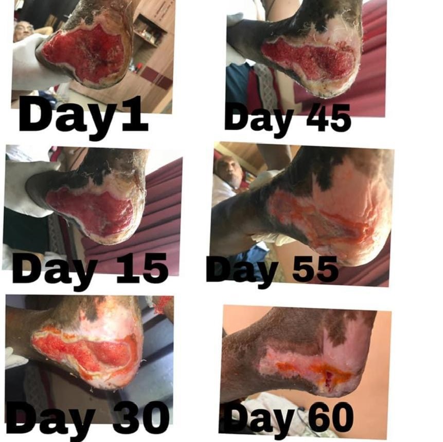 Wonderful results of class 4 LASER in healing non healing wounds and ulcers.