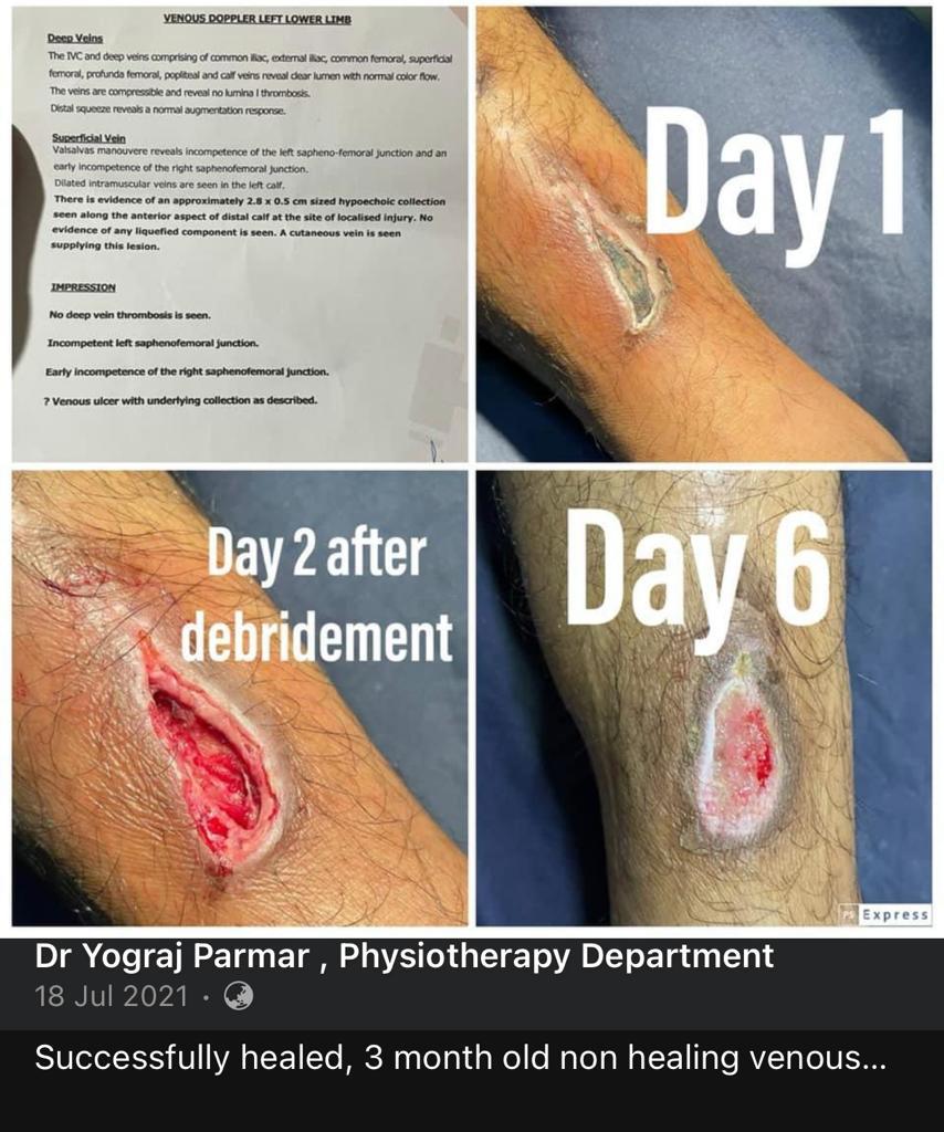 Successfully healed, 3 month old non healing venous ulcer with class 4 LASER.