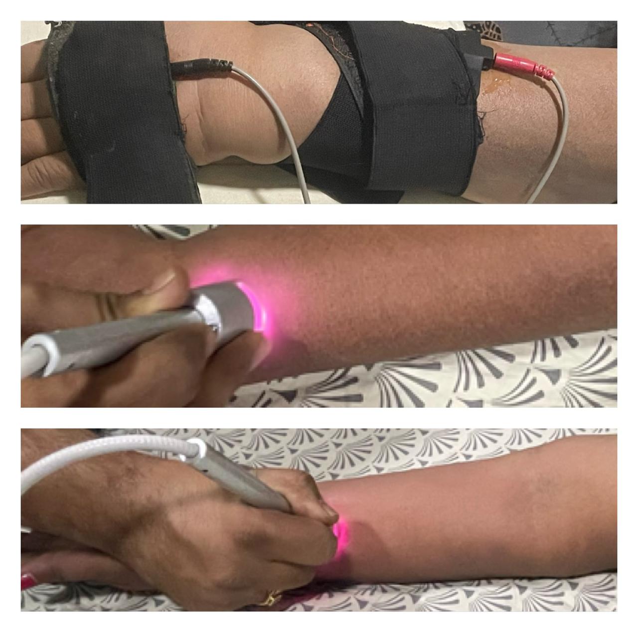 Post cancer operated odema reduced with class 4 LASER