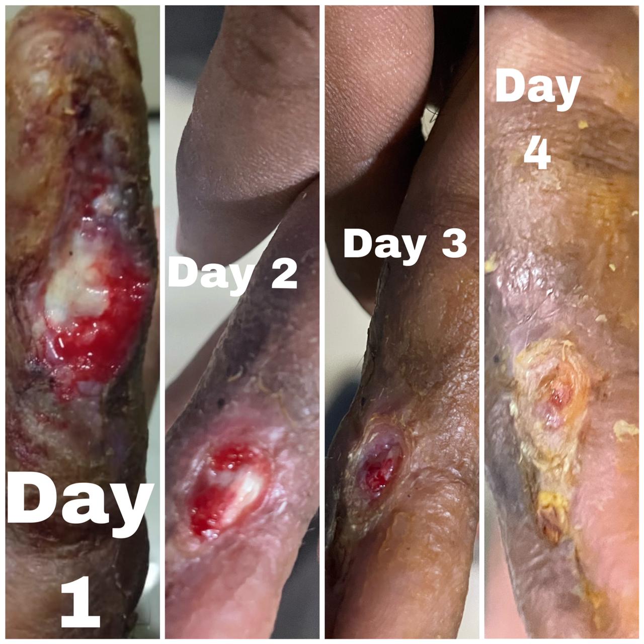 Excellent results in Reduction of odema post cancer surgery with class 4 laser.