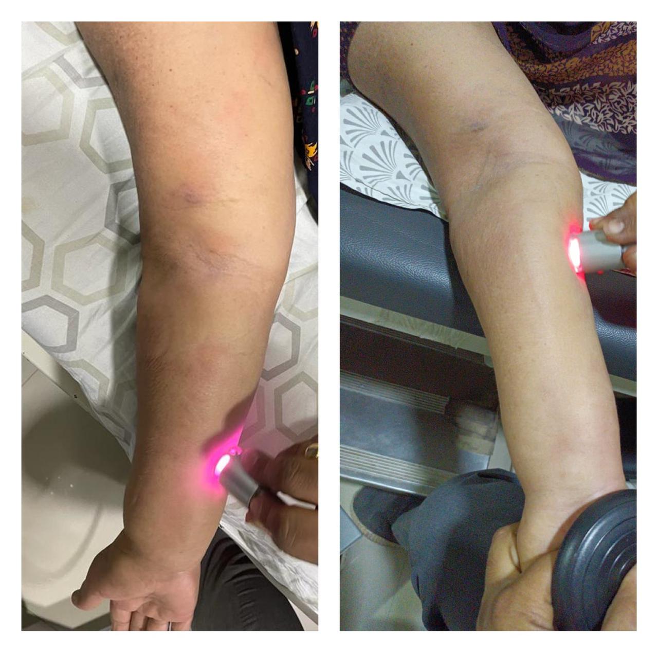 Post cancer operated odema reduced with class 4 LASER